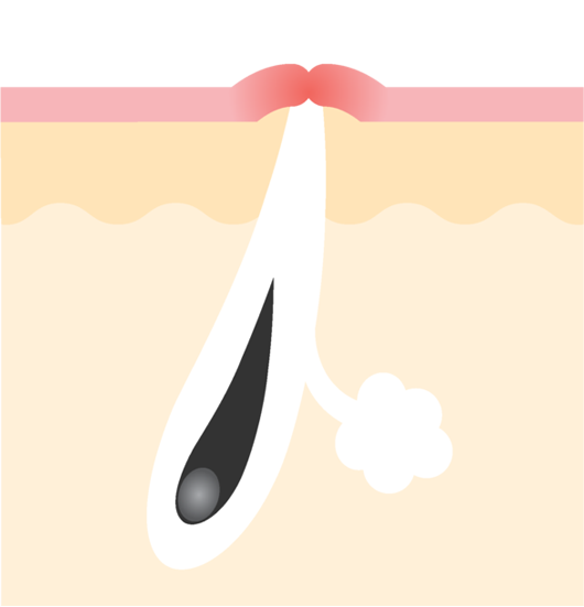 ニキビ跡の赤み