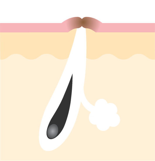 ニキビ跡の色素沈着