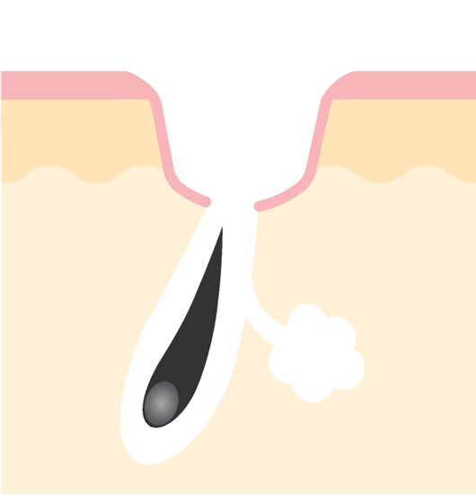 ニキビ跡の凹み